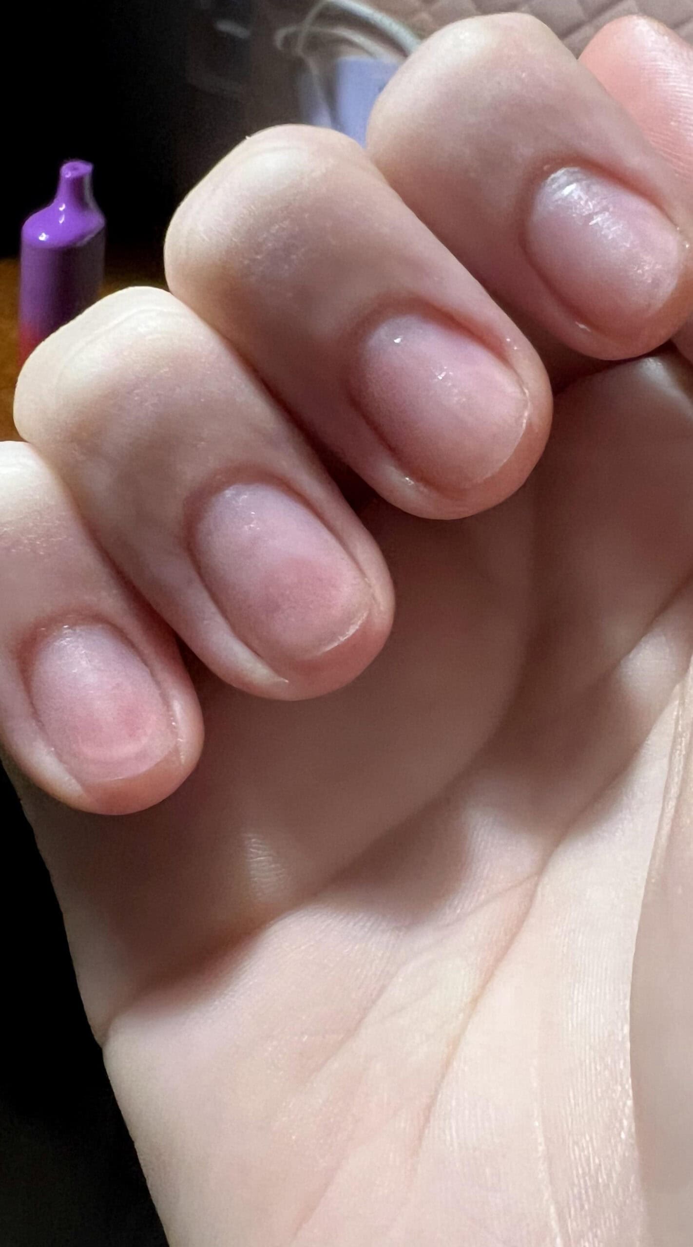 Close-up of short, thin natural nails showing early signs of damage and dryness near the cuticle.